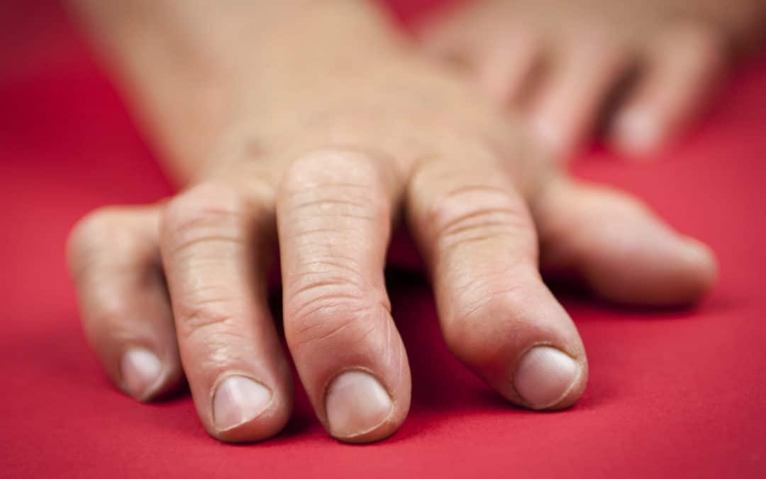 Arthrose aux mains : surveillez votre alimentation